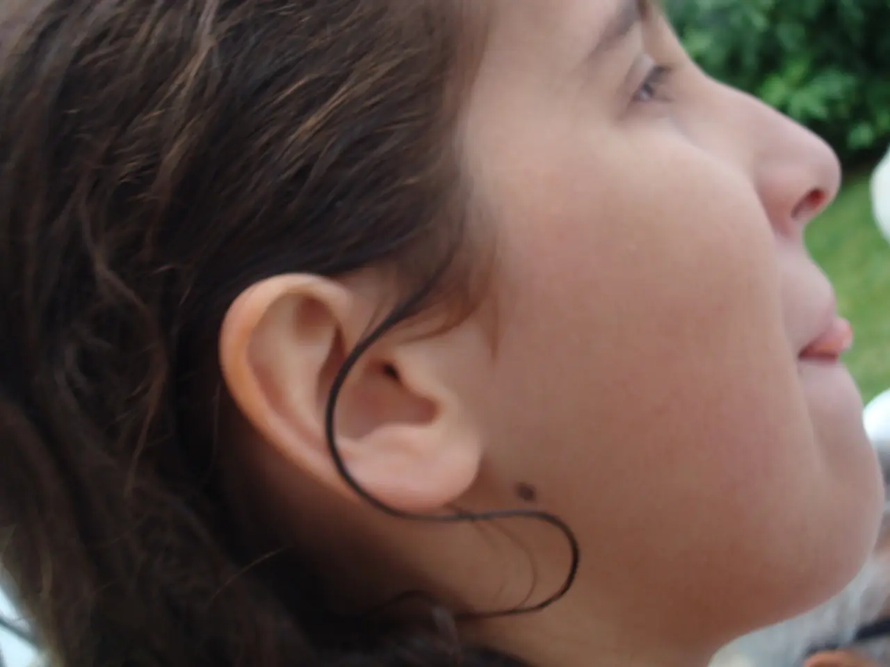 Distinguishing Between Skin Tags and Moles: Their Discrepancies and Shared Qualities