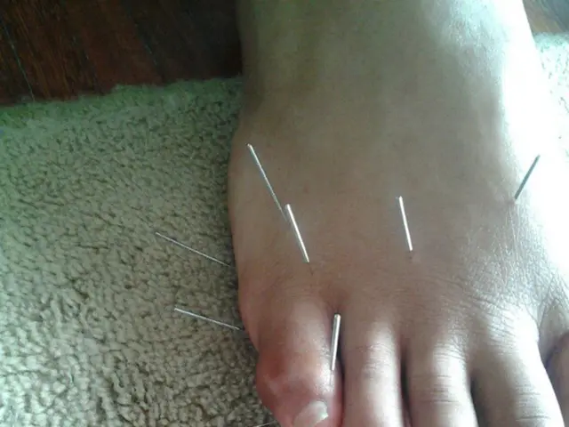 Lifesaving Intervention Through Endovascular Stent Grafting for the Uncommon Problem of Superior...